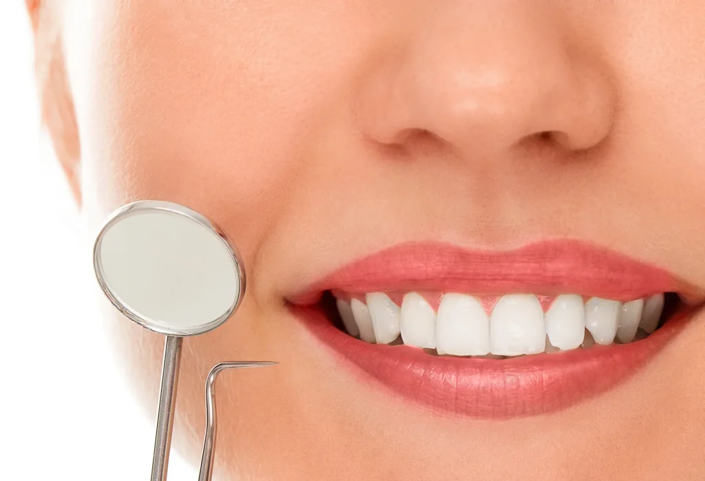 Blanqueamiento Dental Profesional Vs. Casero