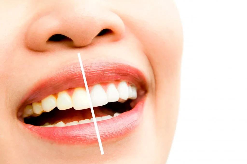 Mitos Sobre El Blanqueamiento Dental