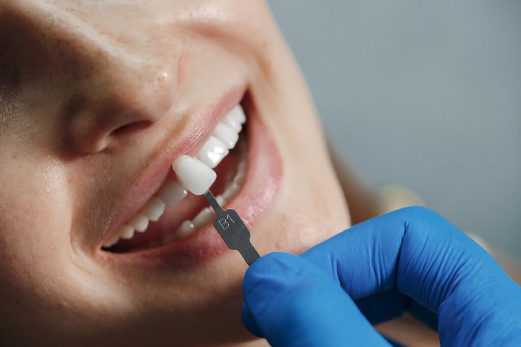 Proceso De Colocación De Implantes Dentales Estéticos