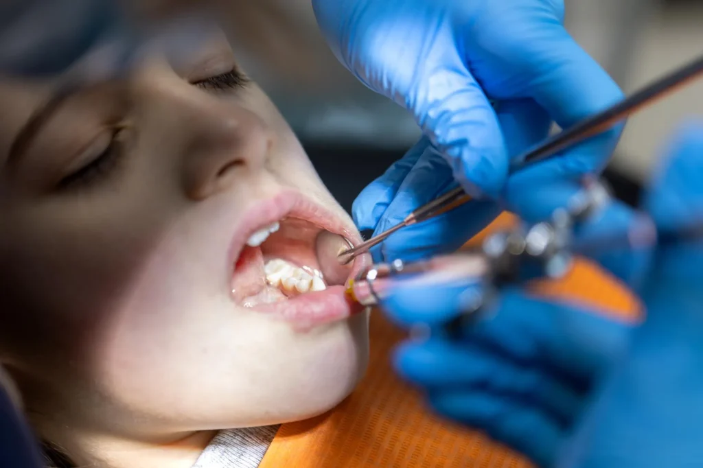 Duración de los selladores dentales en odontopediatría