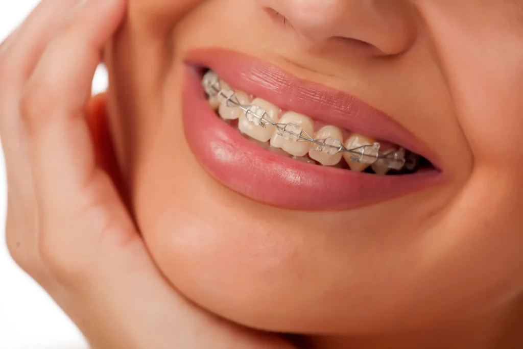 Brackets estéticos en hidalgo