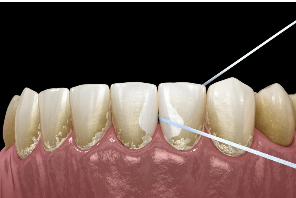 Evita la acumulación de placa en tus prótesis dentales