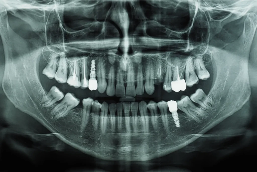 Radiografías periapicales